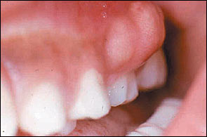 Oral Abscess