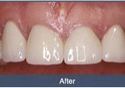 pfm dental crown after