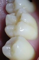 dental fissures and pits caries