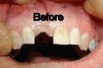 dental implant before