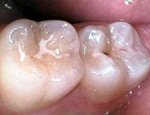 dental sealants