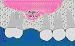 Dental Bone Graft Sinus Lift