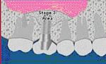 Dental Bone Graft Sinus Lift