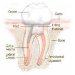 endodontic therapy