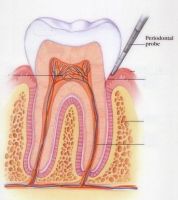 periodontal disease