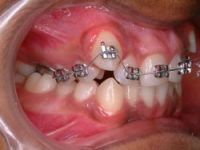 dental braces