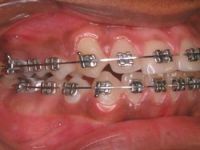 dental braces