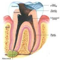 root canal