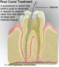 root canal