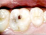 dental cavities