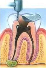 root canal