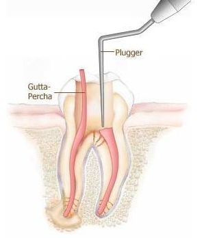 endodontic therapy