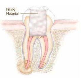 root canal therapy