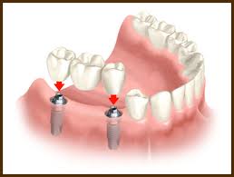 fixed dental bridge