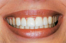 cosmetic dental makeover
