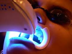 laser teeth whitening