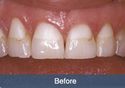 pfm dental crown before