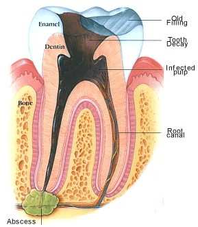 root canal