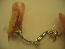 partial denture