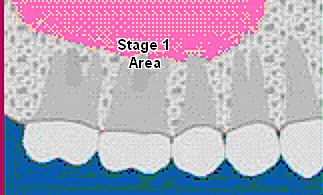 Dental Bone Graft Sinus Lift