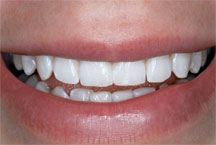 Porcelain or Composite Veneers