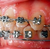 orthodontic braces