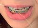 dental braces flossing