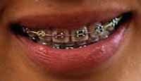 caring for braces