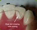 broken dental braces wire