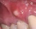 dental abscess